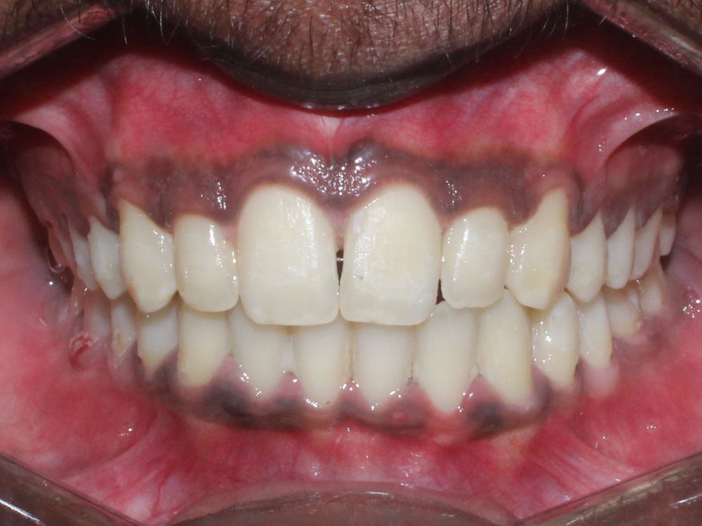 Rotated teeth, after