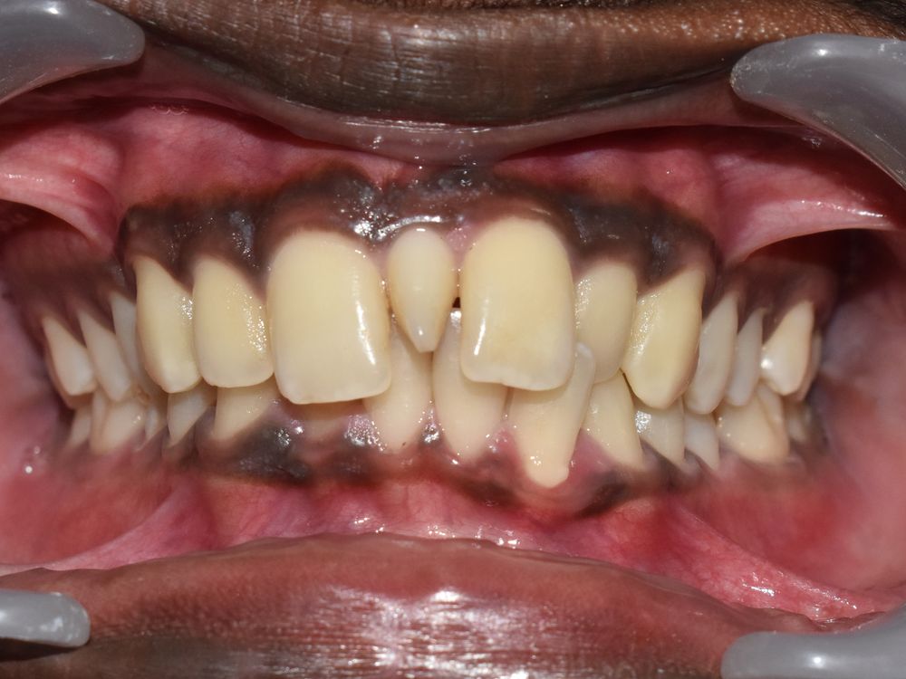 Rotated teeth, before