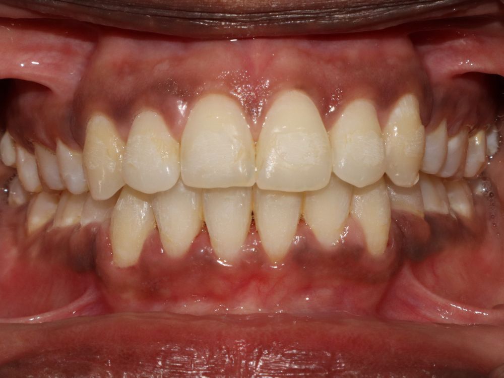 Open bite, after
