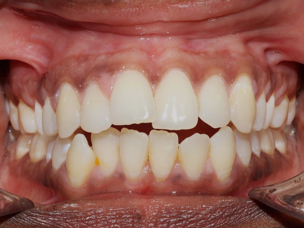 Open bite, before