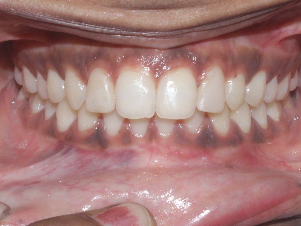 Spacing, after aligners